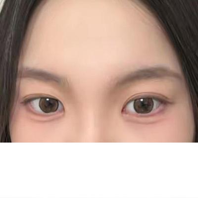 눈성형 환자 후기 — 한달정도 되니까 시술 티는 ... (189)