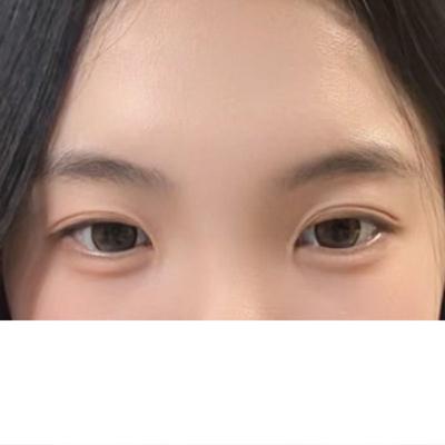 절개 쌍꺼풀 한 달차, 잔붓기 빠지니 다들 예뻐졌다고 해요 사진 2 — 아바성형외과 쌍꺼풀·눈성형 후기