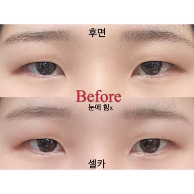 쌍꺼풀 눈매교정 윗트임 2주차, 답답한 눈이 개과천선했어요 사진 2 — 아바성형외과 쌍꺼풀·눈성형 후기