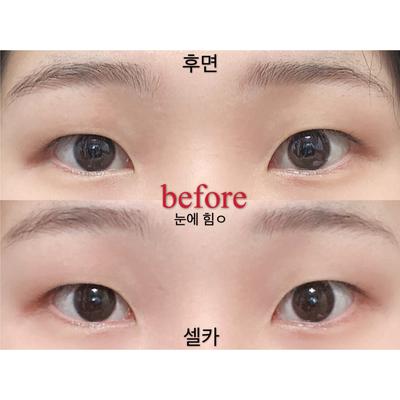 쌍꺼풀 눈매교정 윗트임 2주차, 답답한 눈이 개과천선했어요 사진 3 — 아바성형외과 쌍꺼풀·눈성형 후기