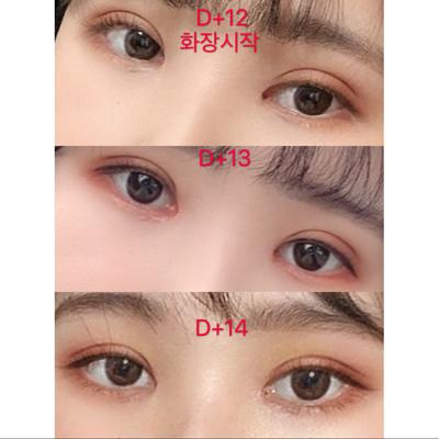 쌍꺼풀 눈매교정 윗트임 2주차, 답답한 눈이 개과천선했어요 사진 5 — 아바성형외과 쌍꺼풀·눈성형 후기