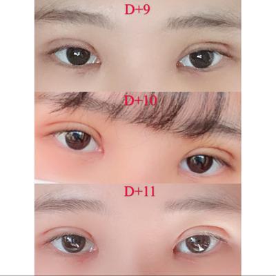 쌍꺼풀 눈매교정 윗트임 2주차, 답답한 눈이 개과천선했어요 사진 6 — 아바성형외과 쌍꺼풀·눈성형 후기
