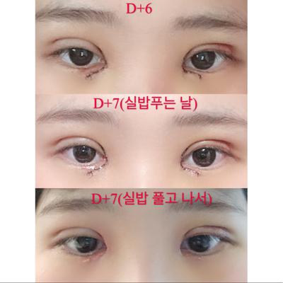 쌍꺼풀 눈매교정 윗트임 2주차, 답답한 눈이 개과천선했어요 사진 7 — 아바성형외과 쌍꺼풀·눈성형 후기