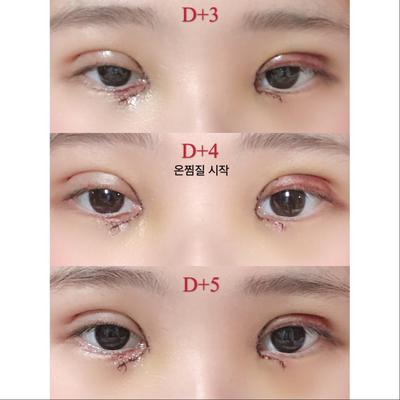 쌍꺼풀 눈매교정 윗트임 2주차, 답답한 눈이 개과천선했어요 사진 8 — 아바성형외과 쌍꺼풀·눈성형 후기
