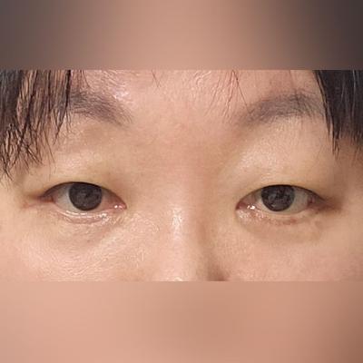 눈밑 수술 후 회복 빠르고 한땀한땀 자연스럽게 됐어요 — 아바성형외과 환자 후기 사진