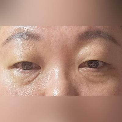 눈밑 수술 후 회복 빠르고 한땀한땀 자연스럽게 됐어요 사진 2 — 아바성형외과 눈밑지방재배치 후기