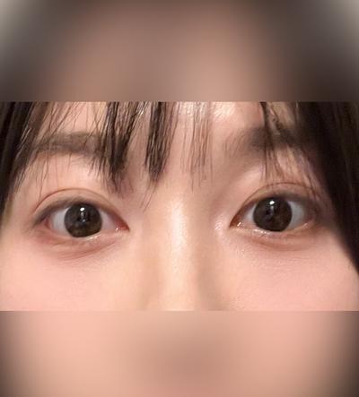 눈밑지방재배치 4주차, 쌩얼도 안색 맑아졌다는 말 들어요 — 아바성형외과 환자 후기 사진