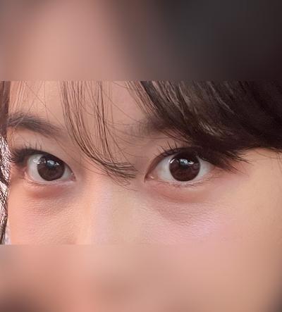 눈밑지방재배치 4주차, 쌩얼도 안색 맑아졌다는 말 들어요 사진 2 — 아바성형외과 눈밑지방재배치 후기