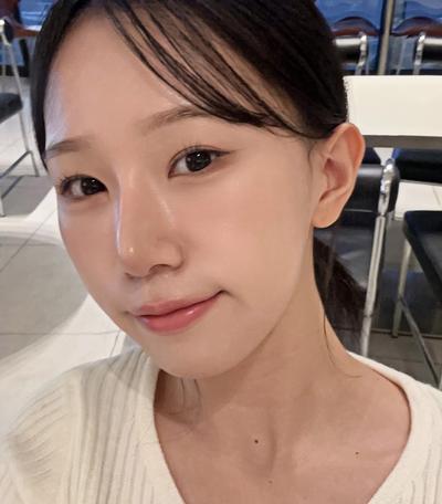 눈밑지방재배치 2주차, 안색 훨 밝아지고 보정도 안 해요 — 아바성형외과 환자 후기 사진