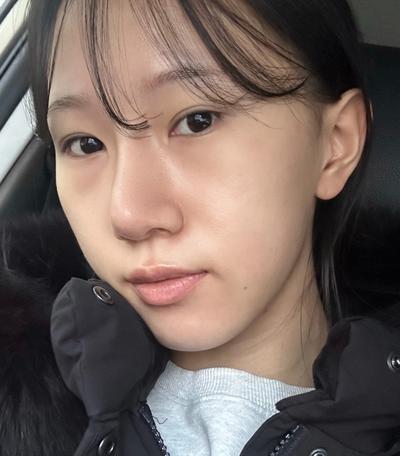눈밑지방재배치 2주차, 안색 훨 밝아지고 보정도 안 해요 사진 2 — 아바성형외과 눈밑지방재배치 후기