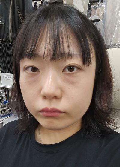 눈밑지방재배치 6주차, 짝짝이 사라지고 눈가가 환해졌어요 사진 2 — 아바성형외과 눈밑지방재배치 후기