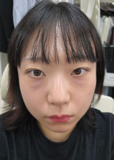 눈밑지방재배치 6주차, 짝짝이 사라지고 눈가가 환해졌어요 사진 3 — 아바성형외과 눈밑지방재배치 후기