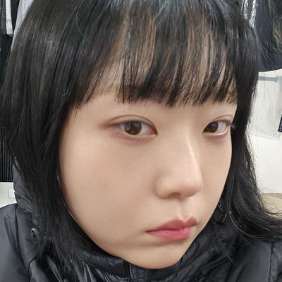 눈밑지방재배치 6주차, 짝짝이 사라지고 눈가가 환해졌어요 사진 4 — 아바성형외과 눈밑지방재배치 후기