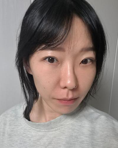 눈밑지방재배치 발품 후기, 상담부터 꼼꼼해서 믿고 맡겼어요 — 아바성형외과 환자 후기 사진