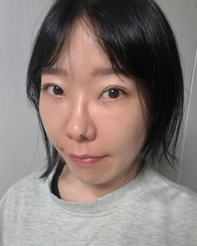눈밑지방재배치 발품 후기, 상담부터 꼼꼼해서 믿고 맡겼어요 사진 3 — 아바성형외과 눈밑지방재배치 후기