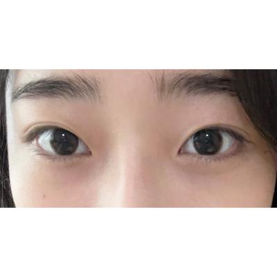 바비톡 통신판매 당사자 아님 책임 관련 안내 문구예요 — 아바성형외과 환자 후기 사진