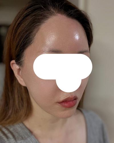 안면거상 아큐 9주차, 라인 정리 확실히 돼서 완전 맘에 들어요 — 아바성형외과 환자 후기 사진
