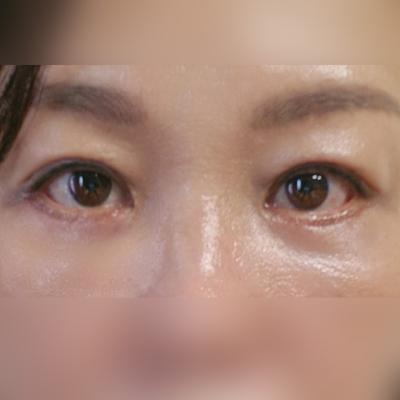눈밑지방재배치＋하안검 4주차, 어머니 눈밑 지방 훨씬 좋아졌어요 — 아바성형외과 환자 후기 사진
