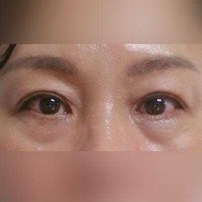 눈밑지방재배치＋하안검 4주차, 어머니 눈밑 지방 훨씬 좋아졌어요 사진 2 — 아바성형외과 눈밑지방재배치 후기