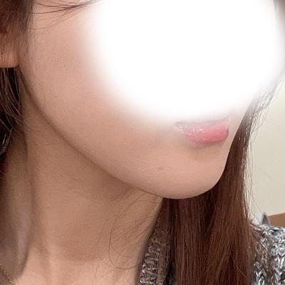 이중턱 근육묶기만 했는데 옆라인이 훨씬 깔끔해졌어요 — 아바성형외과 환자 후기 사진