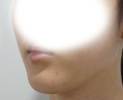 이중턱 근육묶기만 했는데 옆라인이 훨씬 깔끔해졌어요 사진 2 — 아바성형외과 이중턱·윤곽 후기