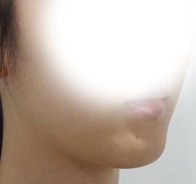 이중턱 근육묶기만 했는데 옆라인이 훨씬 깔끔해졌어요 사진 3 — 아바성형외과 이중턱·윤곽 후기