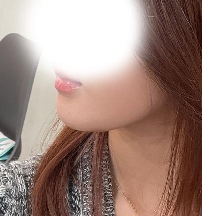 이중턱 근육묶기만 했는데 옆라인이 훨씬 깔끔해졌어요 사진 4 — 아바성형외과 이중턱·윤곽 후기
