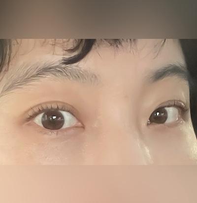 눈밑 수술 6주차, 퀭한 느낌 사라지고 생기 있다는 말 들어요 — 아바성형외과 환자 후기 사진