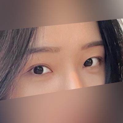 눈밑지방재배치 8주차, 쾡하고 피곤해 보이던 눈밑이 채워졌어요 — 아바성형외과 환자 후기 사진