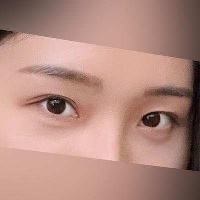 눈밑지방재배치 8주차, 쾡하고 피곤해 보이던 눈밑이 채워졌어요 사진 4 — 아바성형외과 눈밑지방재배치 후기