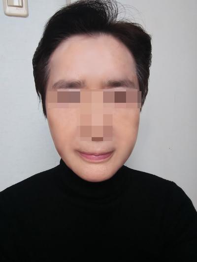 이마거상＋아큐스컬프 두 달 반, 하고 안 하고 차이 너무 커요 — 아바성형외과 환자 후기 사진