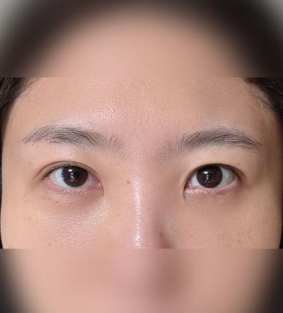지방이식 같이한 후기, 찌릿한 통증 없고 진작 할걸 싶어요 — 아바성형외과 환자 후기 사진