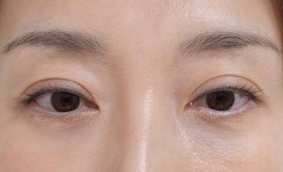 아바성형외과 김승수 원장님 수술 6주차, 잘 유지되고 있어요 — 아바성형외과 환자 후기 사진