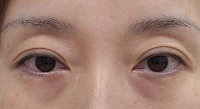 아바성형외과 김승수 원장님 수술 6주차, 잘 유지되고 있어요 사진 2 — 아바성형외과 기타 후기