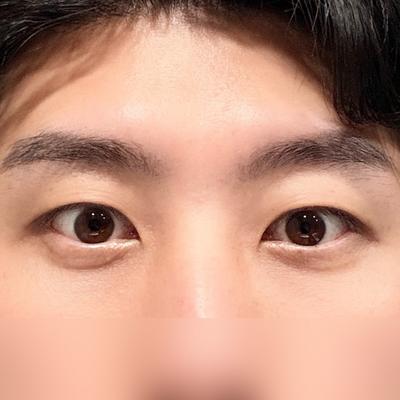 눈밑지방재배치 6주차, 불편함 하나 없고 눈밑 확 정리됐어요 — 아바성형외과 환자 후기 사진