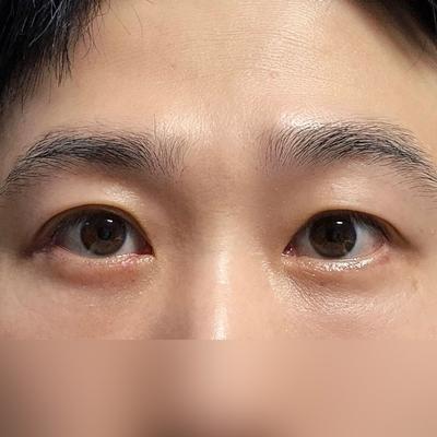 하안검 눈밑지방재배치 6주차, 다크서클 개선돼 인상 밝아졌어요 — 아바성형외과 환자 후기 사진