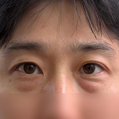 하안검 눈밑지방재배치 6주차, 다크서클 개선돼 인상 밝아졌어요 사진 2 — 아바성형외과 눈밑지방재배치 후기