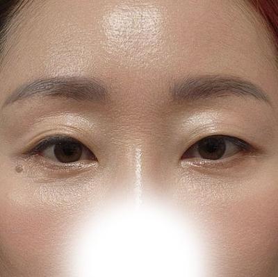 눈밑처짐 수술 6주차, 처짐 개선됐고 인상 밝아졌다는 말 들어요 — 아바성형외과 환자 후기 사진