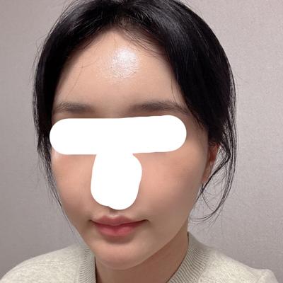 얼굴 지방이식 1차 3주차, 붓기 빠지고 아주 만족스러워요 — 아바성형외과 환자 후기 사진