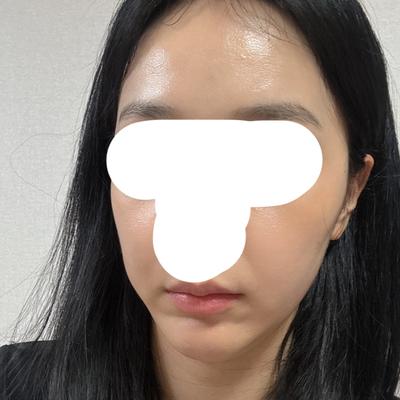 얼굴 지방이식 1차 3주차, 붓기 빠지고 아주 만족스러워요 사진 3 — 아바성형외과 지방이식 후기