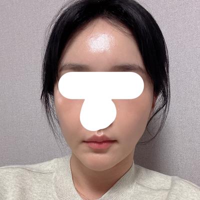 얼굴 지방이식 1차 3주차, 붓기 빠지고 아주 만족스러워요 사진 4 — 아바성형외과 지방이식 후기