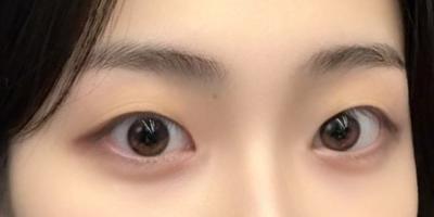 쌍꺼풀 십매몰 트임 9주차, 원래보다 만족도 더 높아요 사진 2 — 아바성형외과 쌍꺼풀·눈성형 후기