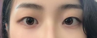쌍꺼풀 십매몰 트임 9주차, 원래보다 만족도 더 높아요 사진 3 — 아바성형외과 쌍꺼풀·눈성형 후기