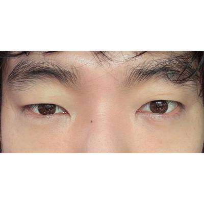 수술 4주차 사진, 붓기 많이 빠졌고 원장님 최고예요 — 아바성형외과 환자 후기 사진