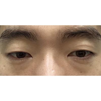 수술 4주차 사진, 붓기 많이 빠졌고 원장님 최고예요 사진 2 — 아바성형외과 기타 후기