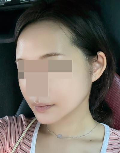 아큐·거상 5주차, 얼굴 작아지고 선 정리됐다는 말 들어요 — 아바성형외과 환자 후기 사진