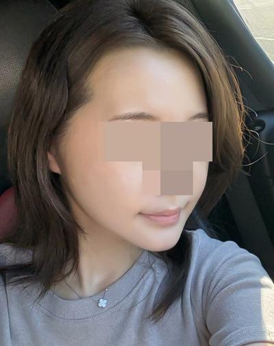 아큐·거상 5주차, 얼굴 작아지고 선 정리됐다는 말 들어요 사진 4 — 아바성형외과 안면거상 후기