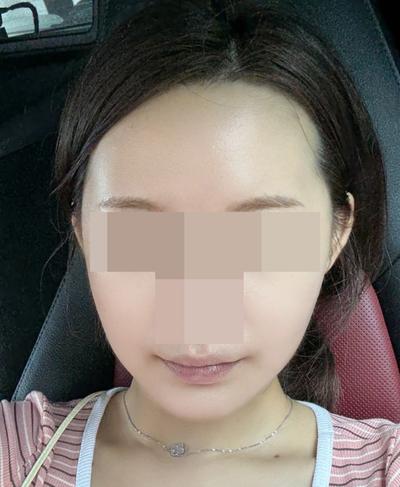 아큐·거상 5주차, 얼굴 작아지고 선 정리됐다는 말 들어요 사진 5 — 아바성형외과 안면거상 후기