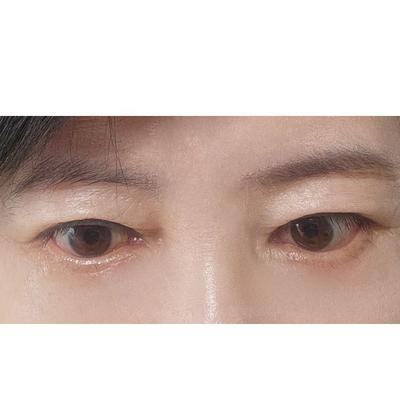 하안검 후기, 눈가 잔주름이 다림질한 것처럼 쫙 펴졌어요 — 아바성형외과 환자 후기 사진