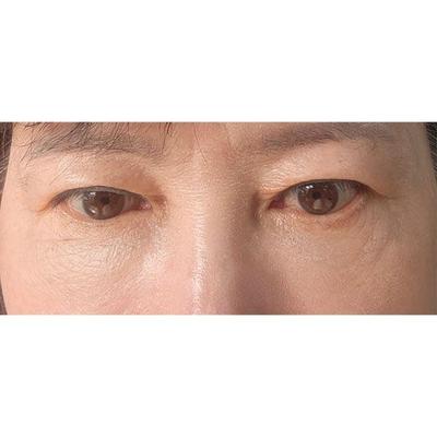 하안검 후기, 눈가 잔주름이 다림질한 것처럼 쫙 펴졌어요 사진 2 — 아바성형외과 하안검 후기
